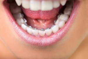 L'ORTHODONTIE LINGUALE INVISIBLE